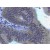 Immunohistochemistry-Paraffin: MMP3 Antibody (SB14d) [HRP] [NBP1-28616] - Paraffin embedded sections of human colon carcinoma. Goat Anti-Mouse IgG2a, human ads-BIOT and Streptavidin-HRP were used and then developed with DAB.